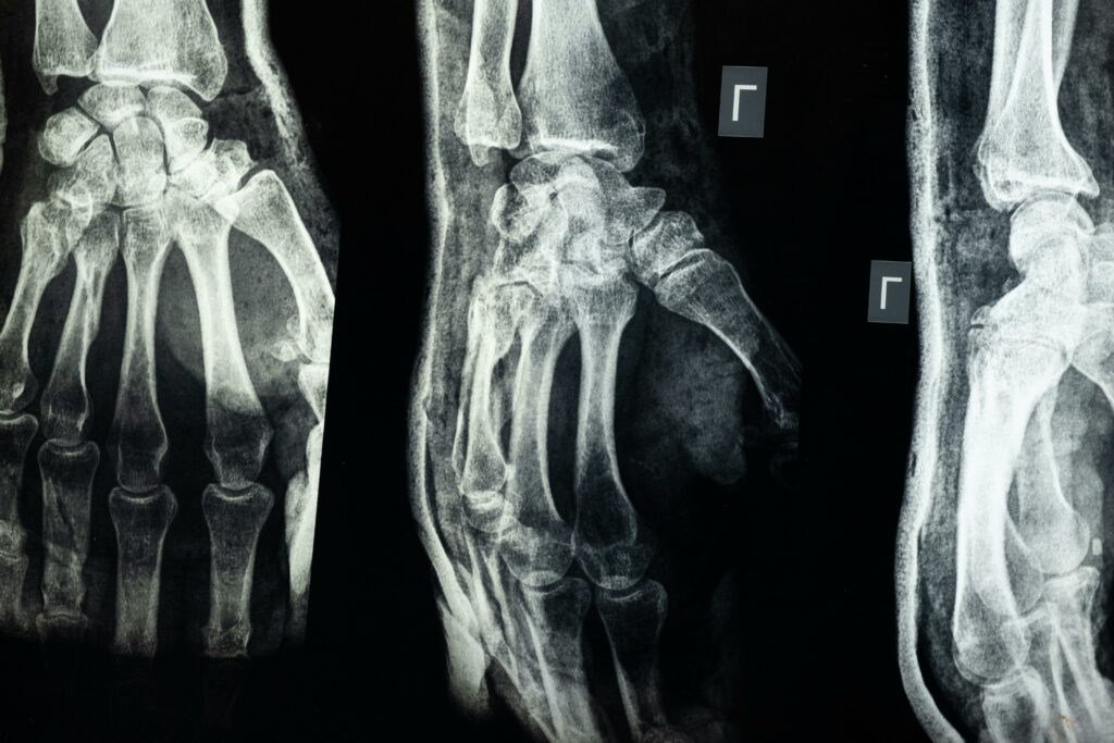 Drei Röntgenbilder einer Hand.